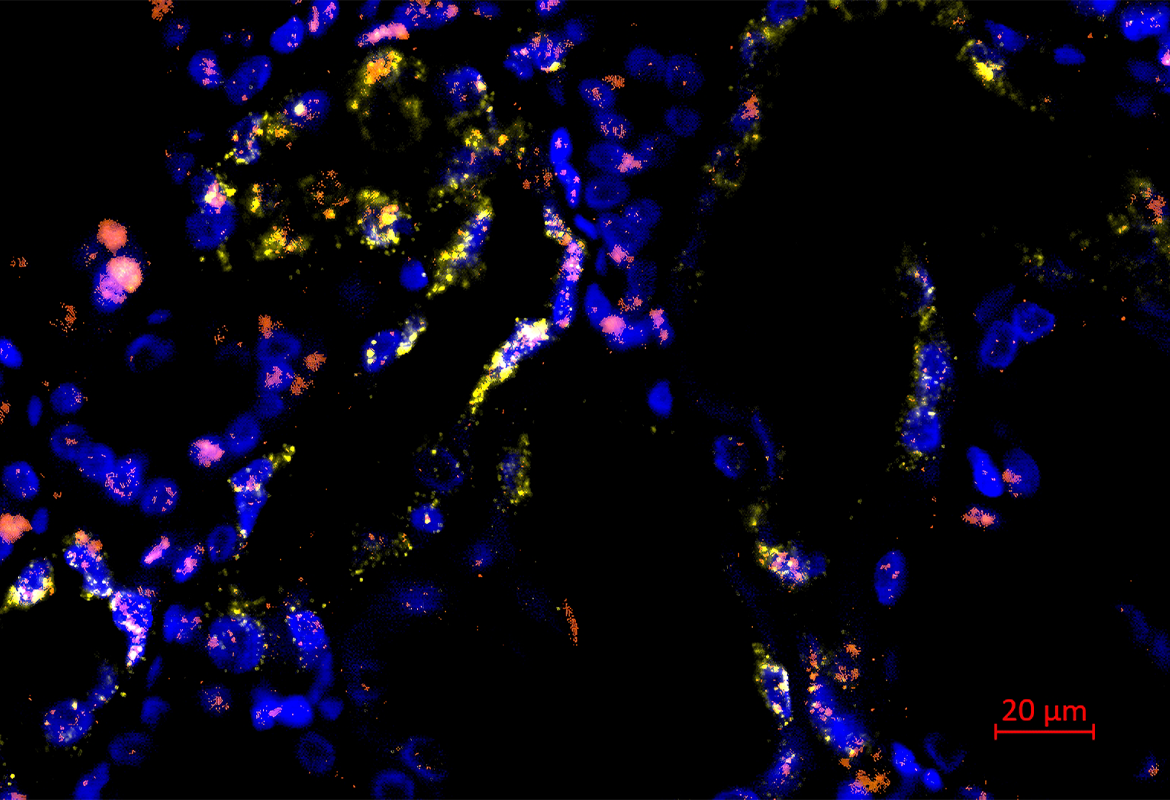 modifiziert nach Hinze et al., Genome Medicine 2022