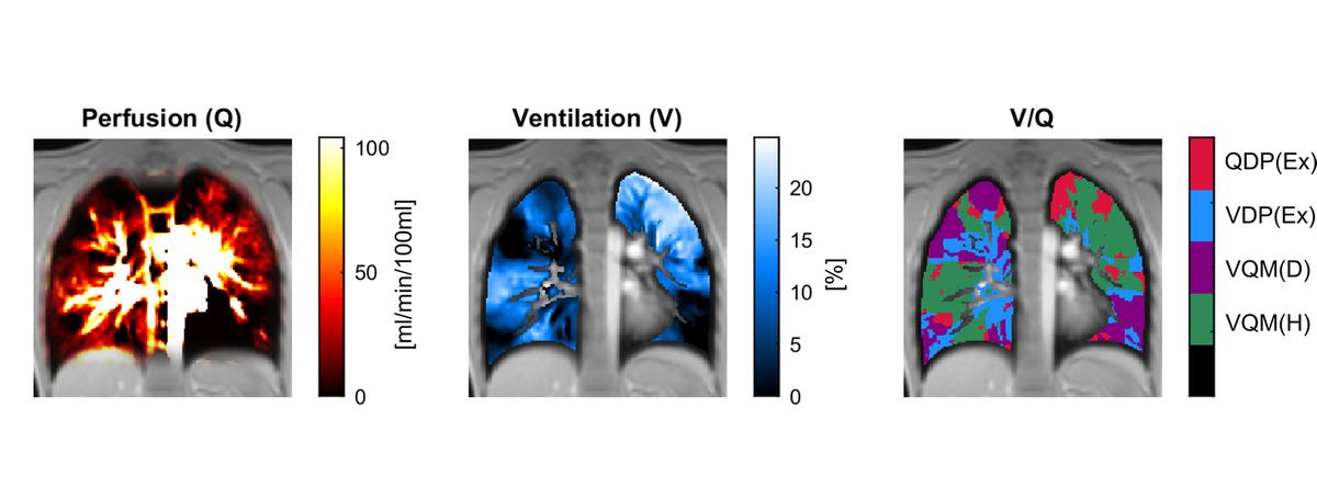 Three exemplary PREFUL images of a cystic fibrosis patient