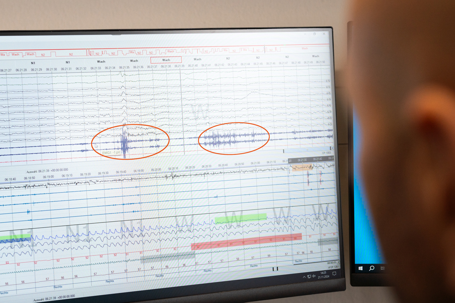 Auf einem Computerbildschirm werden die verschiedenen Aktivitäten im Hirn der Proband:innen als Wellen dargestellt. In den REM-Schlaf-Phasen sind bei der Muskelaktivität deutliche Ausschläge zu erkennen. . 